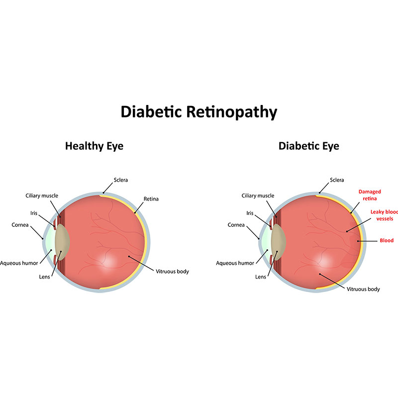 diabetic eye