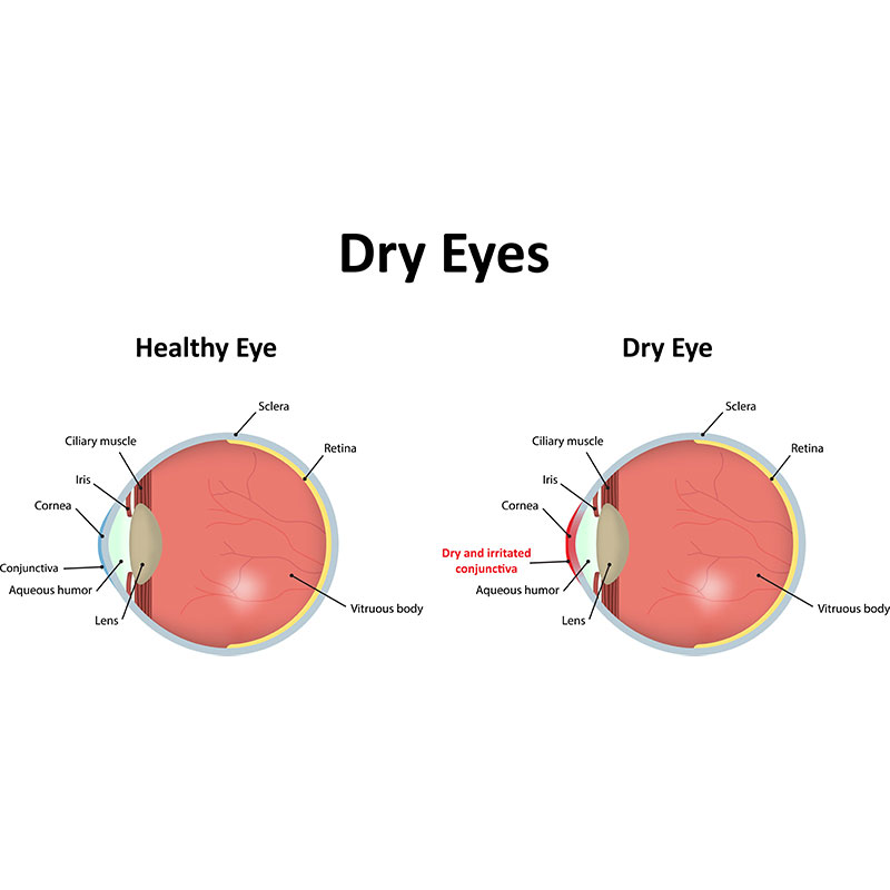 dry eyes